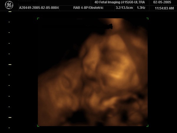 3D ultrasound done at 33 weeks! Photo